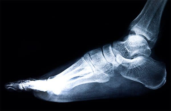 Consequences of Broken Bones and Fractures
